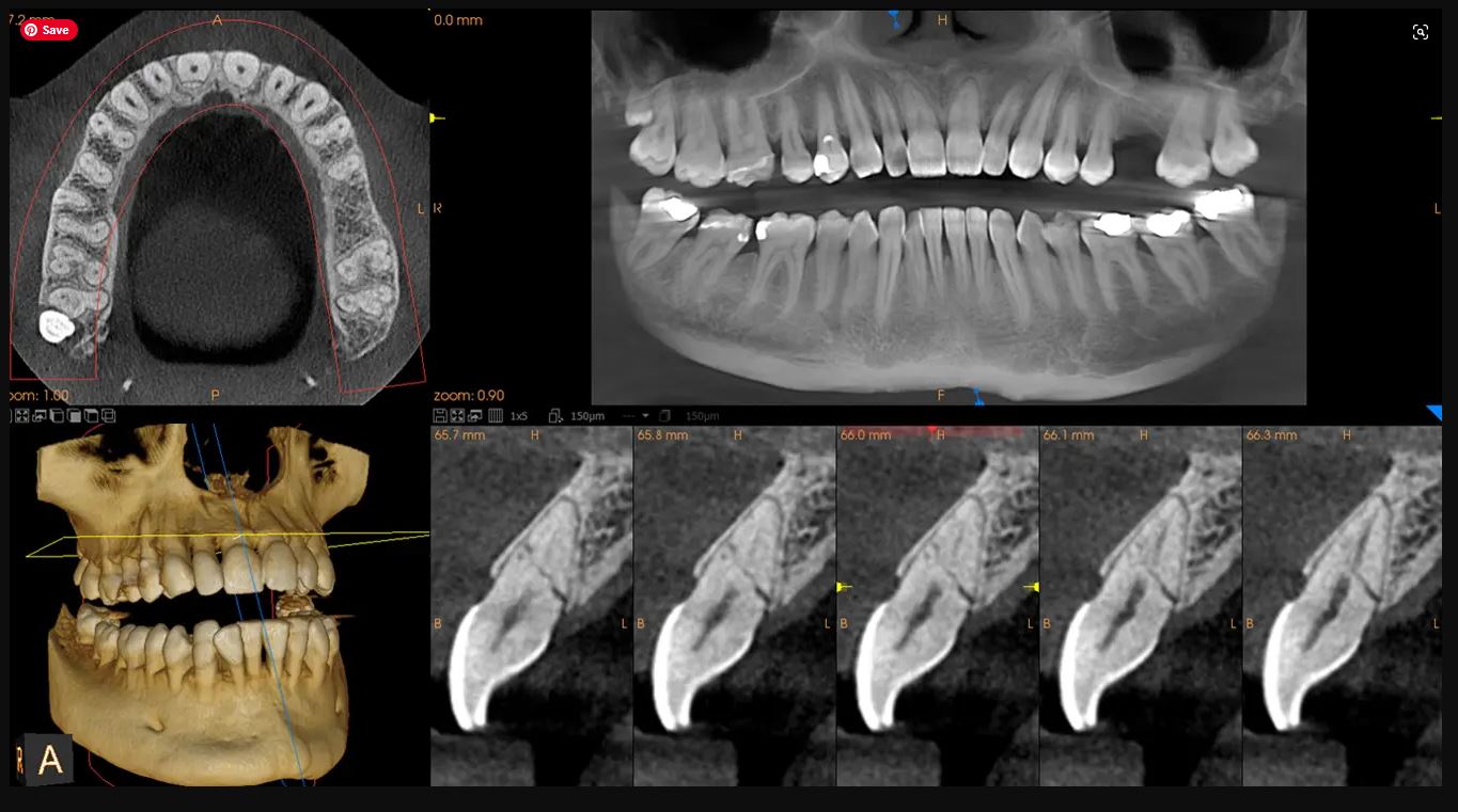 CBCT